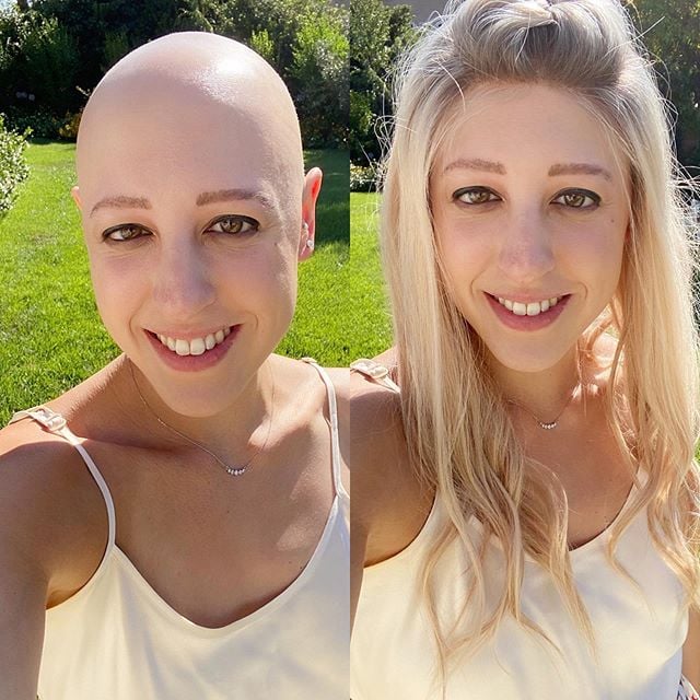Types of wigs for cancer patients hotsell